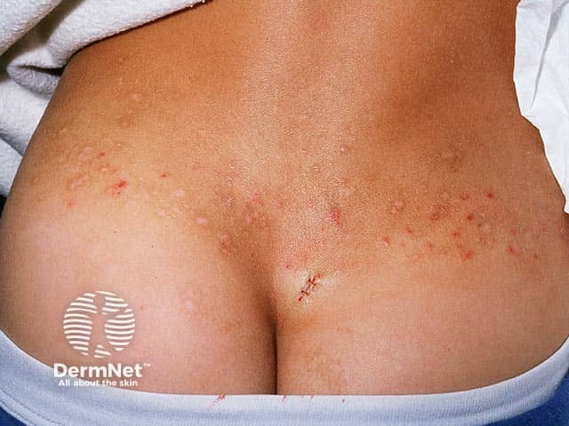 Excoriations and scars over the hips and sacrum in dermatitis herpetiformis