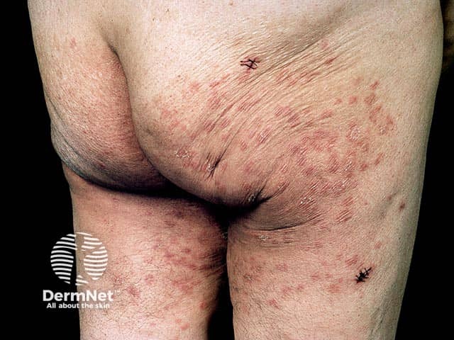 Hip and buttock dermatitis herpetiformis