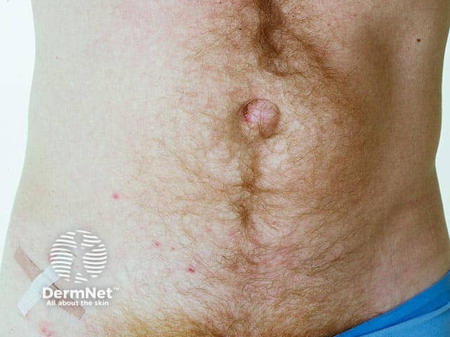 Scattered lower abdominal excoriated papules in dermatitis herpetiformis