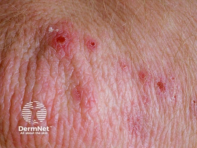 Dermatitis Herpetiformis Images DermNet Dermatitis Herpetiformis Images DermNet