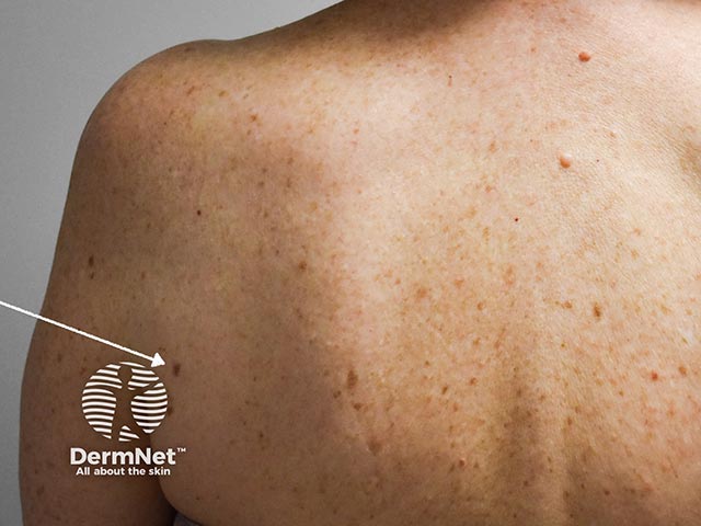 A dermatofibroma on the shoulder