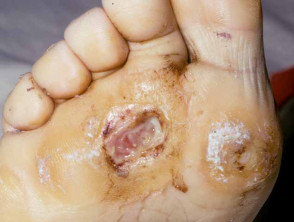 diabetic foot ulcer 00004