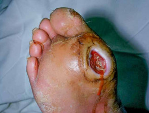 diabetic foot ulcer 00020