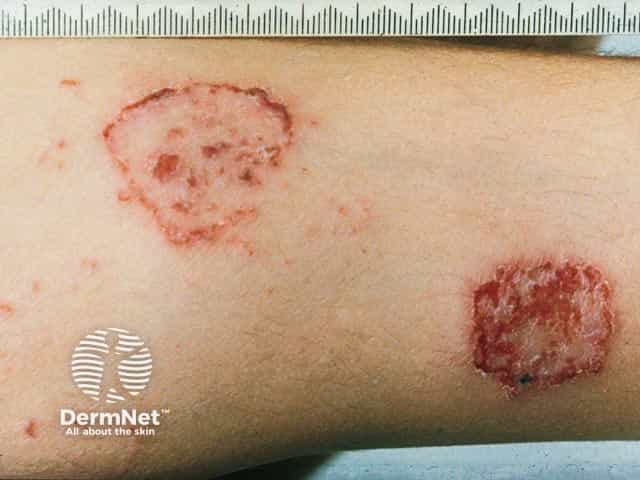 Well circumscribed discoid eczema on the leg