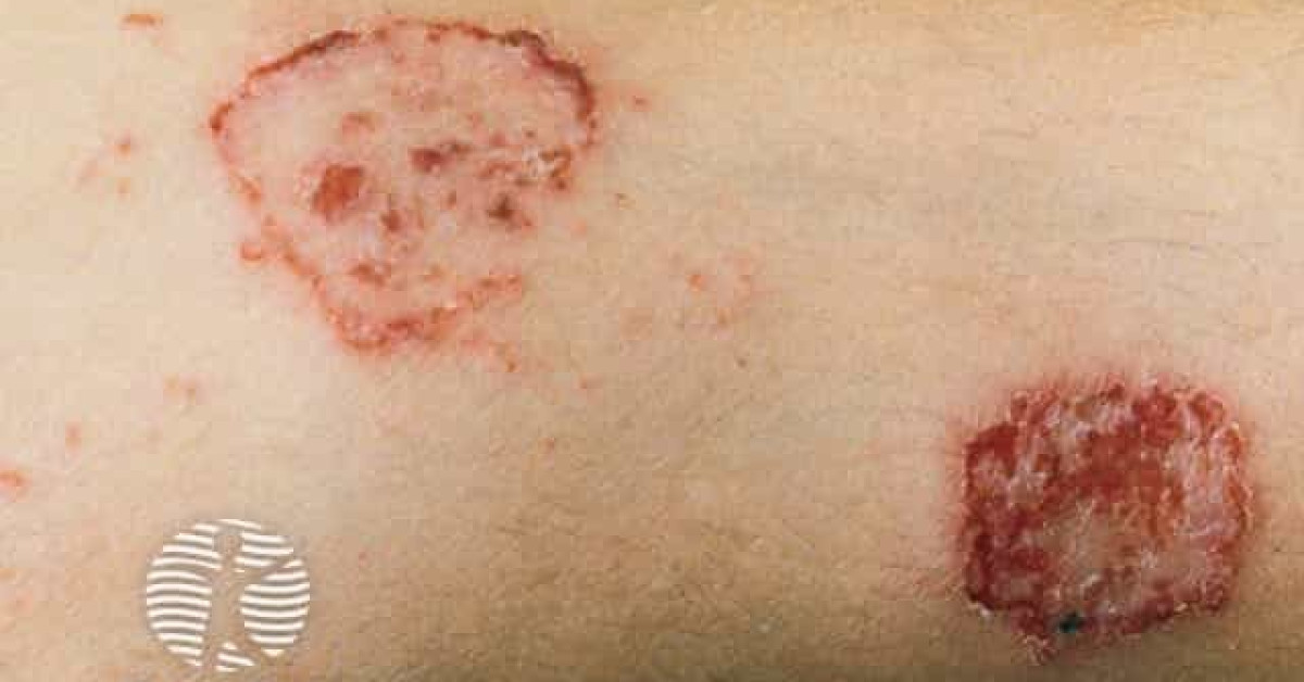 Discoid eczema image