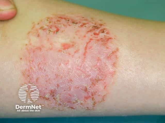 Discoid eczema on the lower leg