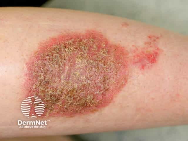 Discoid eczema on the shin
