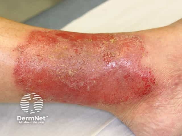 Discoid eczema over the gaiter area of the lower leg