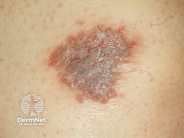 Oozing discoid eczema