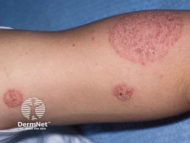 Scattered patches of discoid eczema on the leg