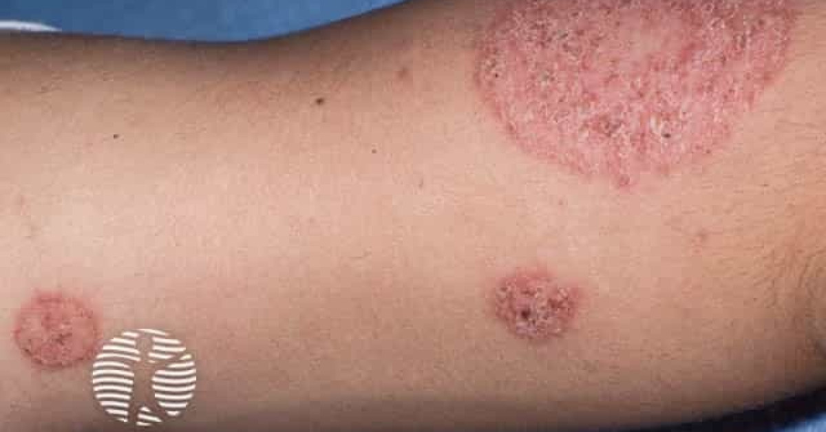 Discoid eczema image