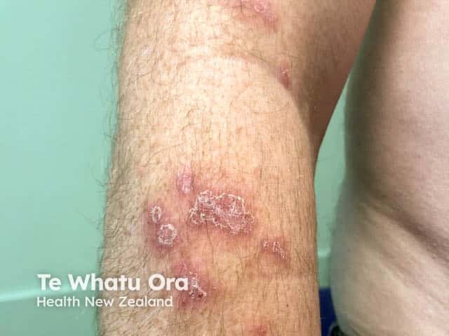 DIscoid eczema on the arm