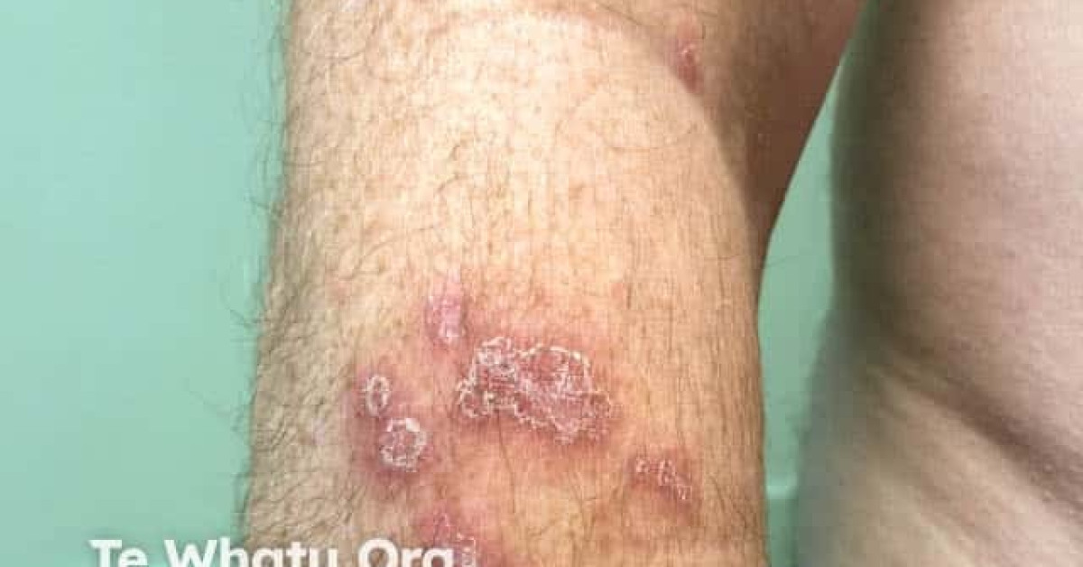 Discoid eczema image