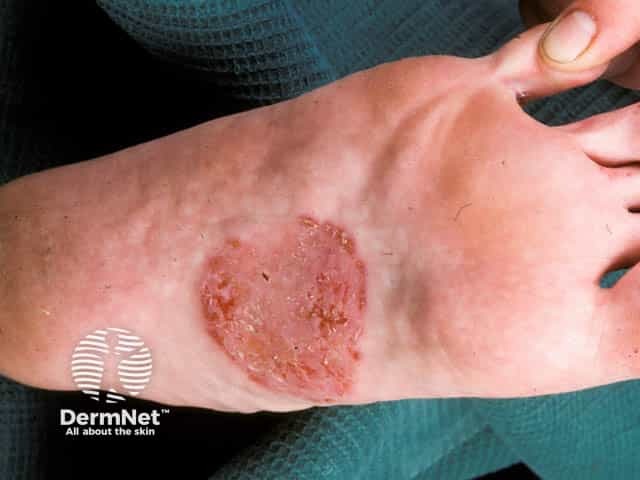 Discoid eczema on the instep