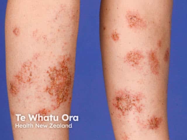 Scattered patches of discoid eczema on the legs