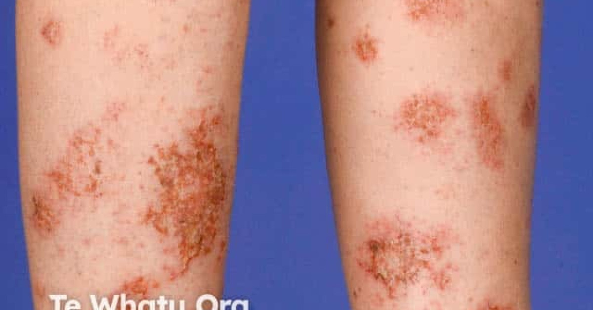 Discoid Eczema Picture