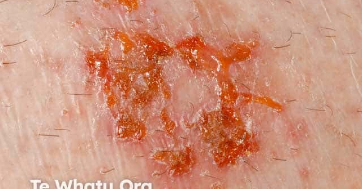 Discoid eczema image