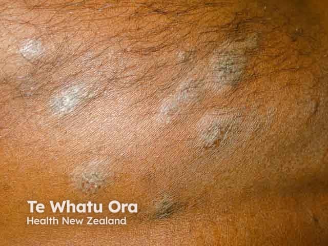 Discoid eczema in skin of colour showing hyperpigmentation