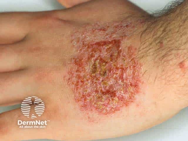 Weepy discoid eczema on the dorsal hand