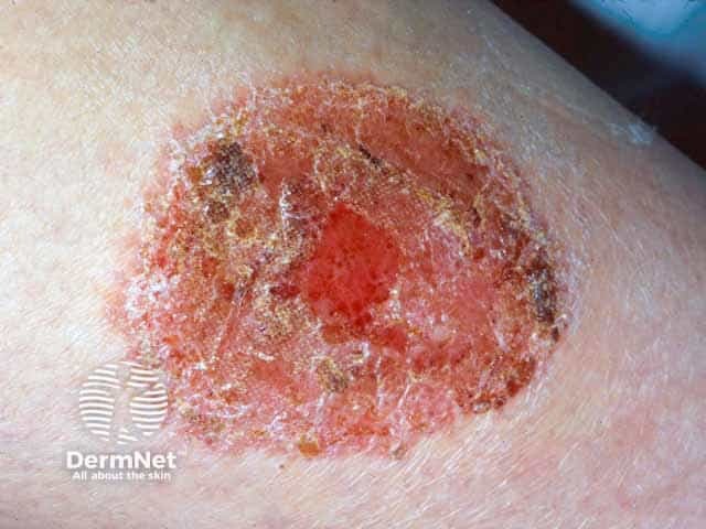 Oozing and eroded discoid eczema
