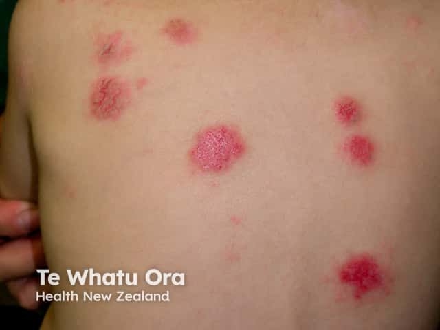 Scattered lesions of discoid eczema on the back