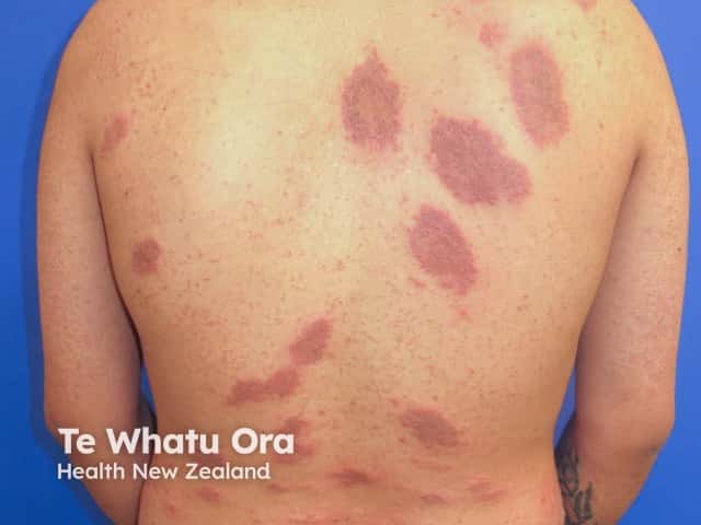 Discoid eczema and keratosis pilaris on the back