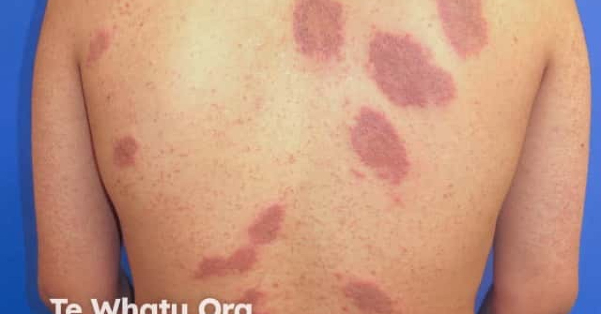Discoid eczema image