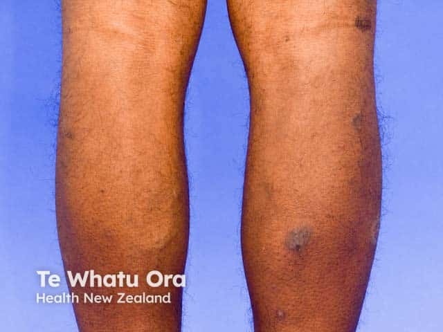 Discoid eczema on the leg in skin of colour