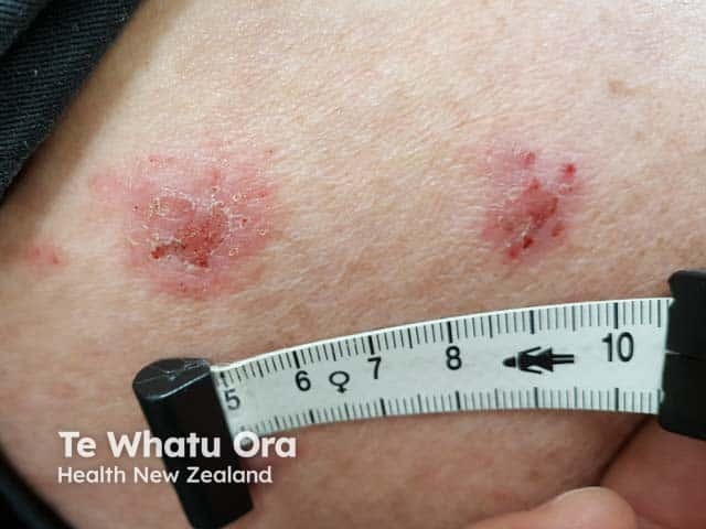 Discoid eczema on the thigh