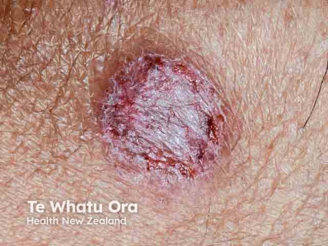 Discoid eczema close up