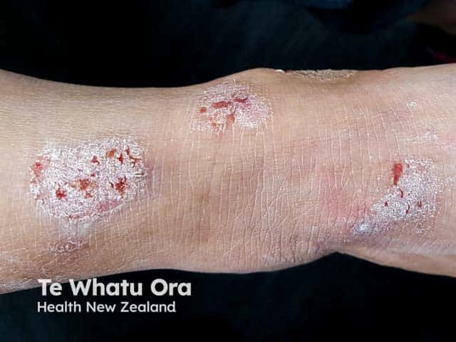 Discoid eczema on the ankle in skin of colour