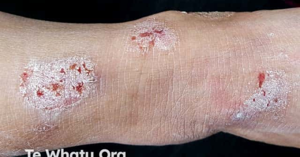 DermNet® - Discoid eczema image