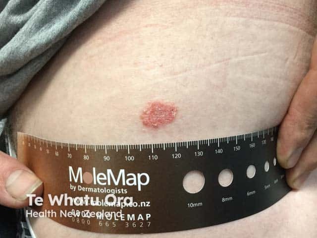 A patch of discoid eczema