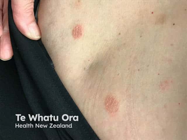 Discoid eczema on the back