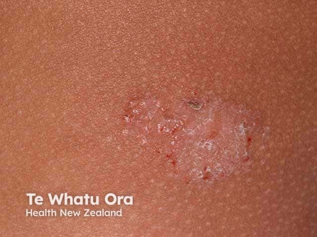 Discoid eczema close up