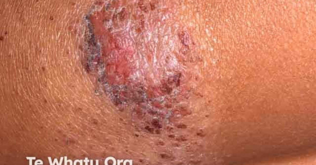 Discoid eczema image