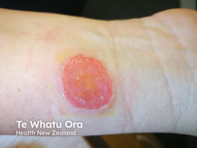 Discoid eczema on the wrist