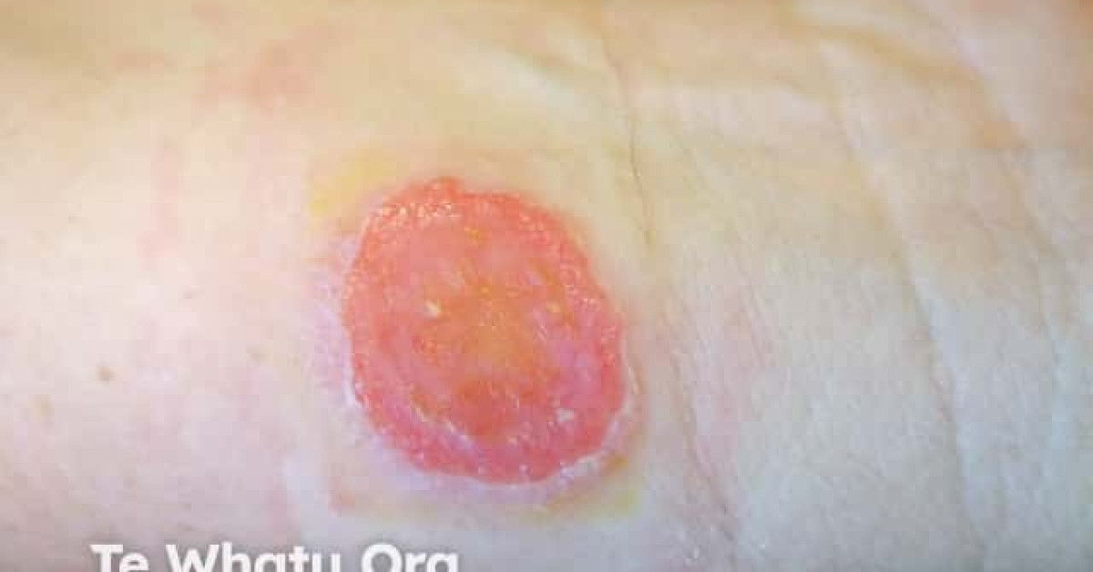 DermNet® - Discoid eczema image