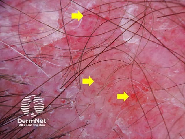 Dermoscopic image of discoid lupus erythematosus showing arborizing blood vessels (yellow arrows)