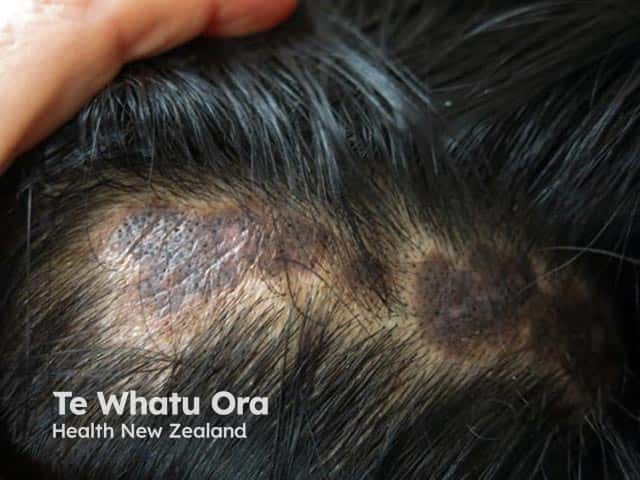 Scarring alopecia due to discoid lupus erythematosus