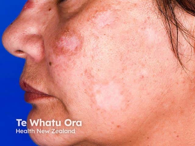 Active inflammatory discoid lupus erythematosus with hypopigmented scarred areas on the cheek