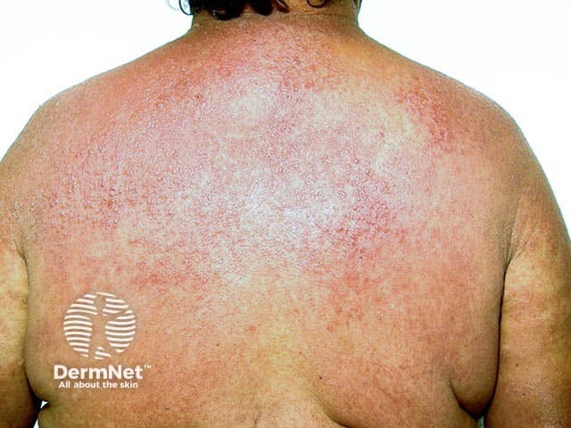 Doxycycline-induced phototoxic eruption on the back after sunbathing