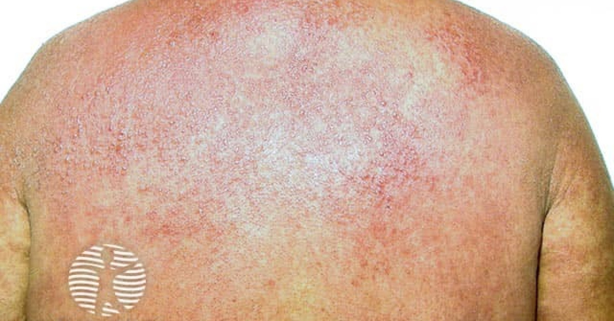 Drug-induced photosensitivity image