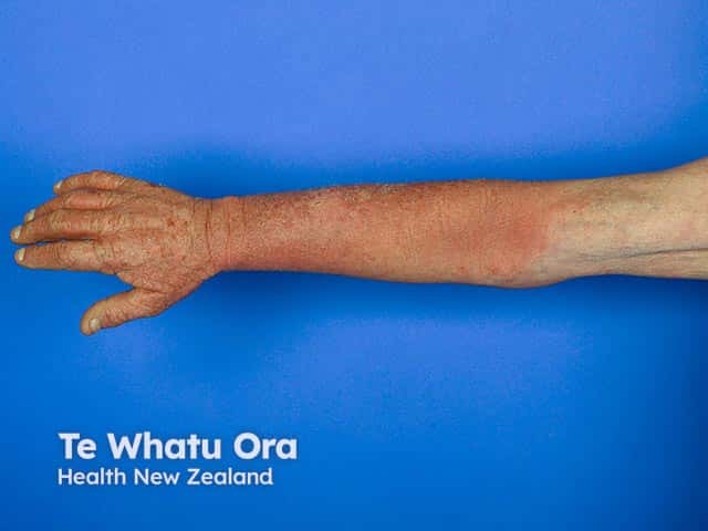 Thiazide photosensitivity on the arm where he does not wear his watch