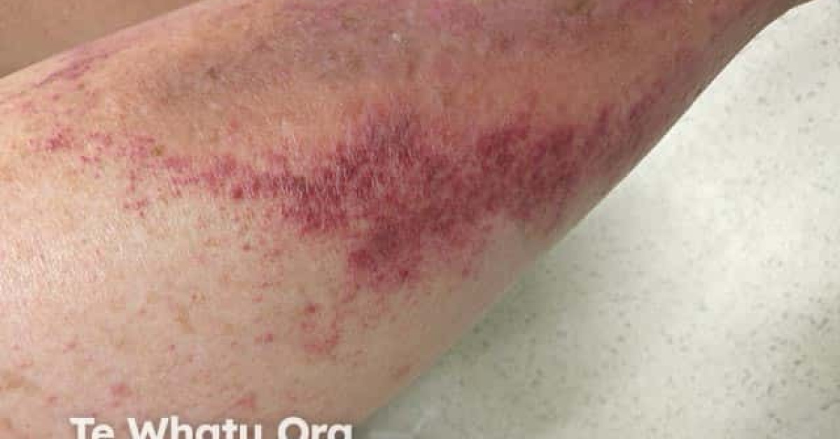 Drug-induced photosensitivity image