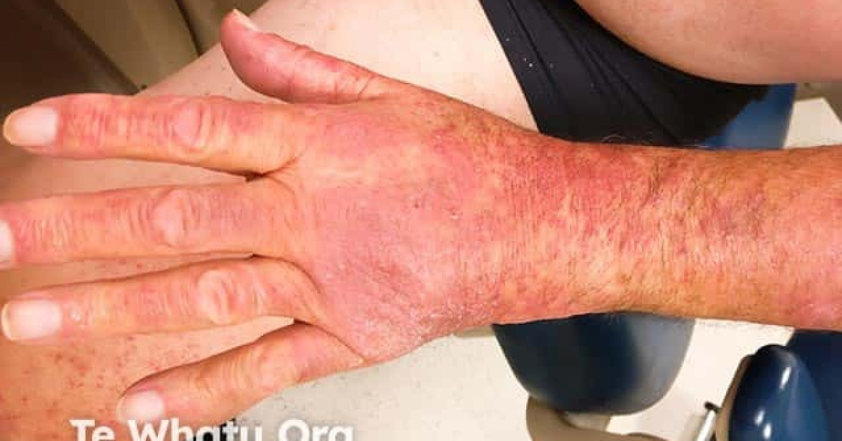 Drug-induced photosensitivity image