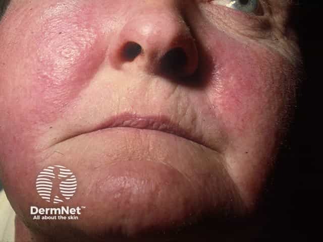 A phototoxic drug eruption - note the sparing of the relatively shaded nasolabial folds