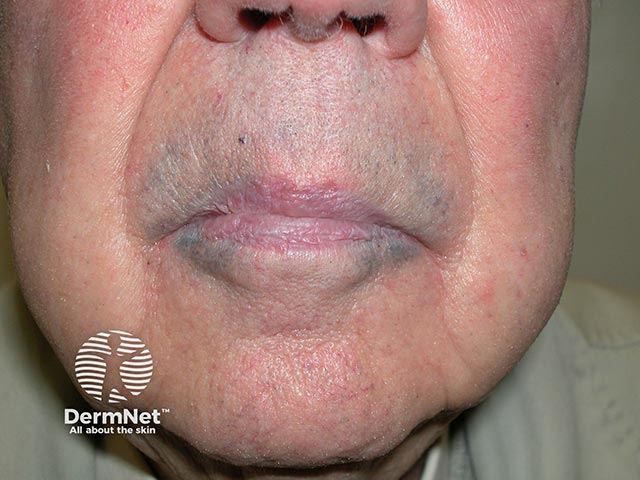 Minocycline-induced blue-grey pigmentation around the lips
