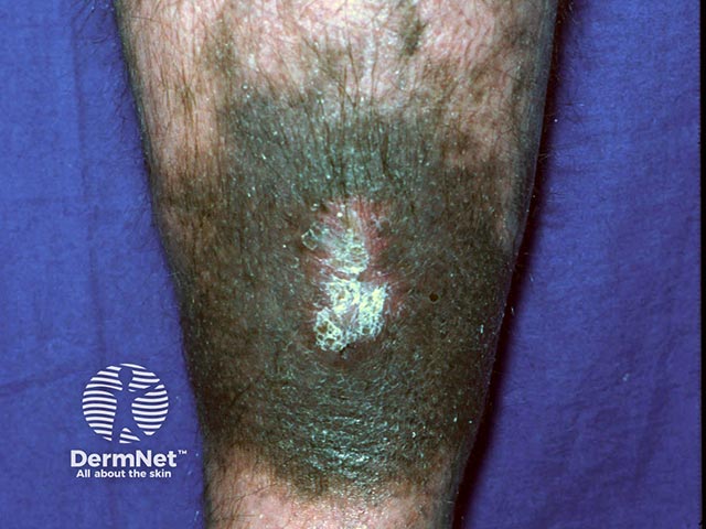 Minocycline-induced pigmentation in a healed pyoderma gangrenosum ulcer