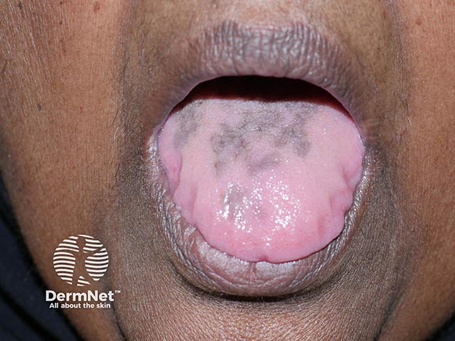 Lingual blue-black pigmentation on the tongue due to hydroxychloroquine
